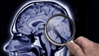 Dünya Alzheimer günü: Belirtileri neler, hangi tedaviler uygulanıyor?