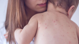 Kızamık yeniden yayılıyor: Avrupa ve Orta Asya’da vakalar yüzde 47 arttı